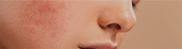 Greeny Acne ∙ Flushing